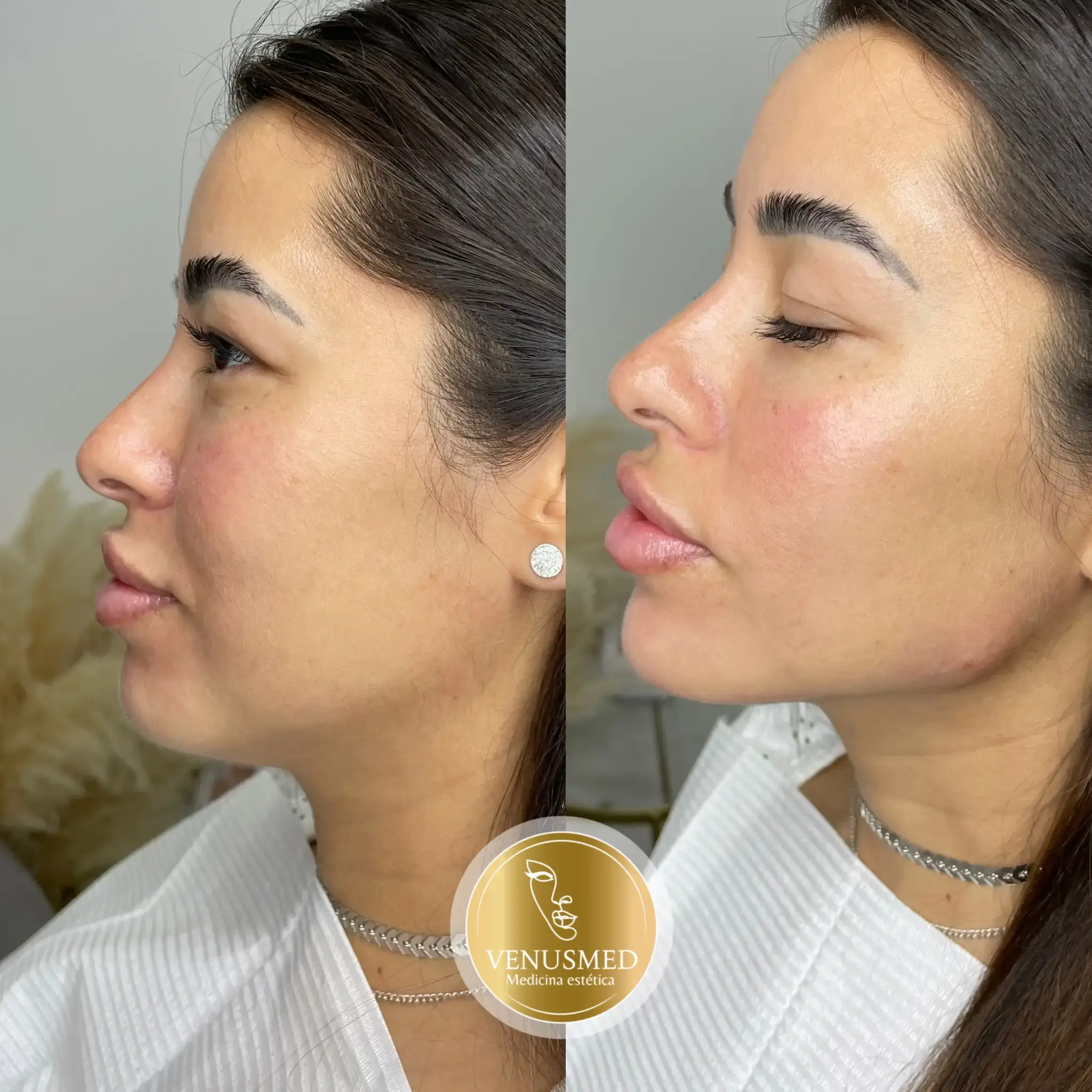 Marcación mandibular con ácido hialurónico