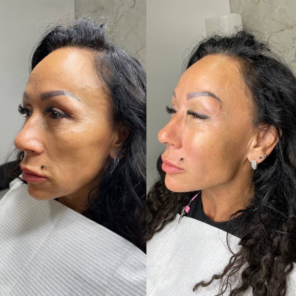 Dos vistas de tres cuartos para comparar mejilla, mentón y contorno facial.