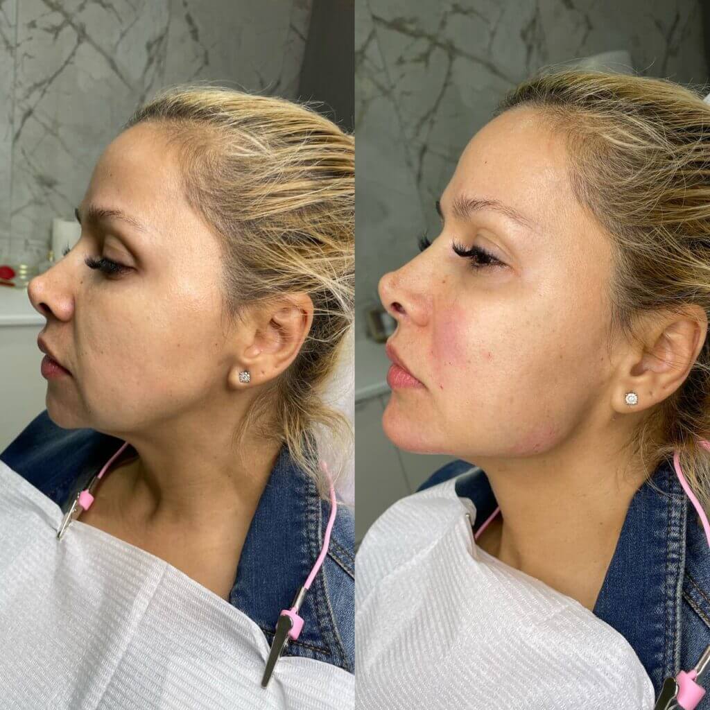Comparativa de perfil del rostro y la línea mandibular.