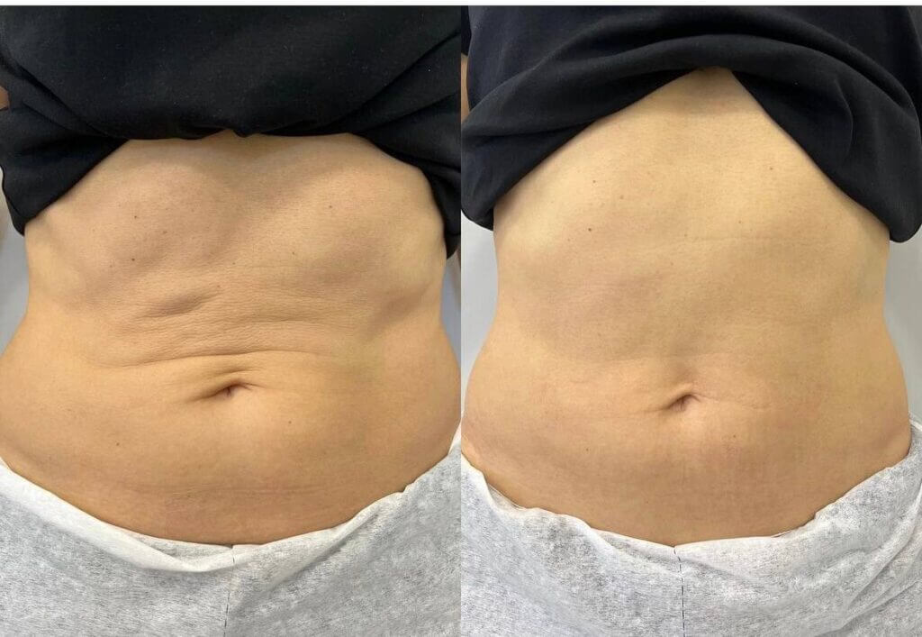 Dos fotografías frontales del abdomen y la cintura.