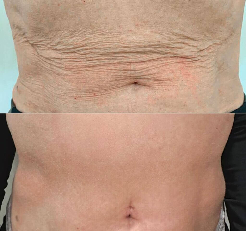 Comparativa del abdomen y los pliegues de la piel en dos fotografías.