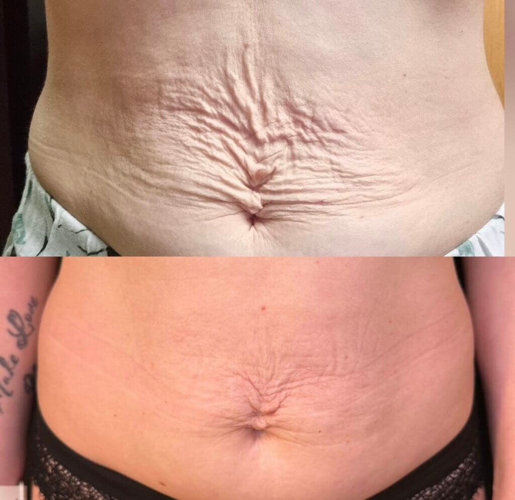Comparativa frontal de la textura de la piel del abdomen.