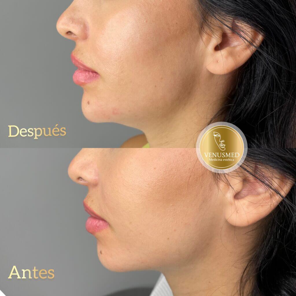 Comparativa del perfil del mentón con las etiquetas «Después» y «Antes».