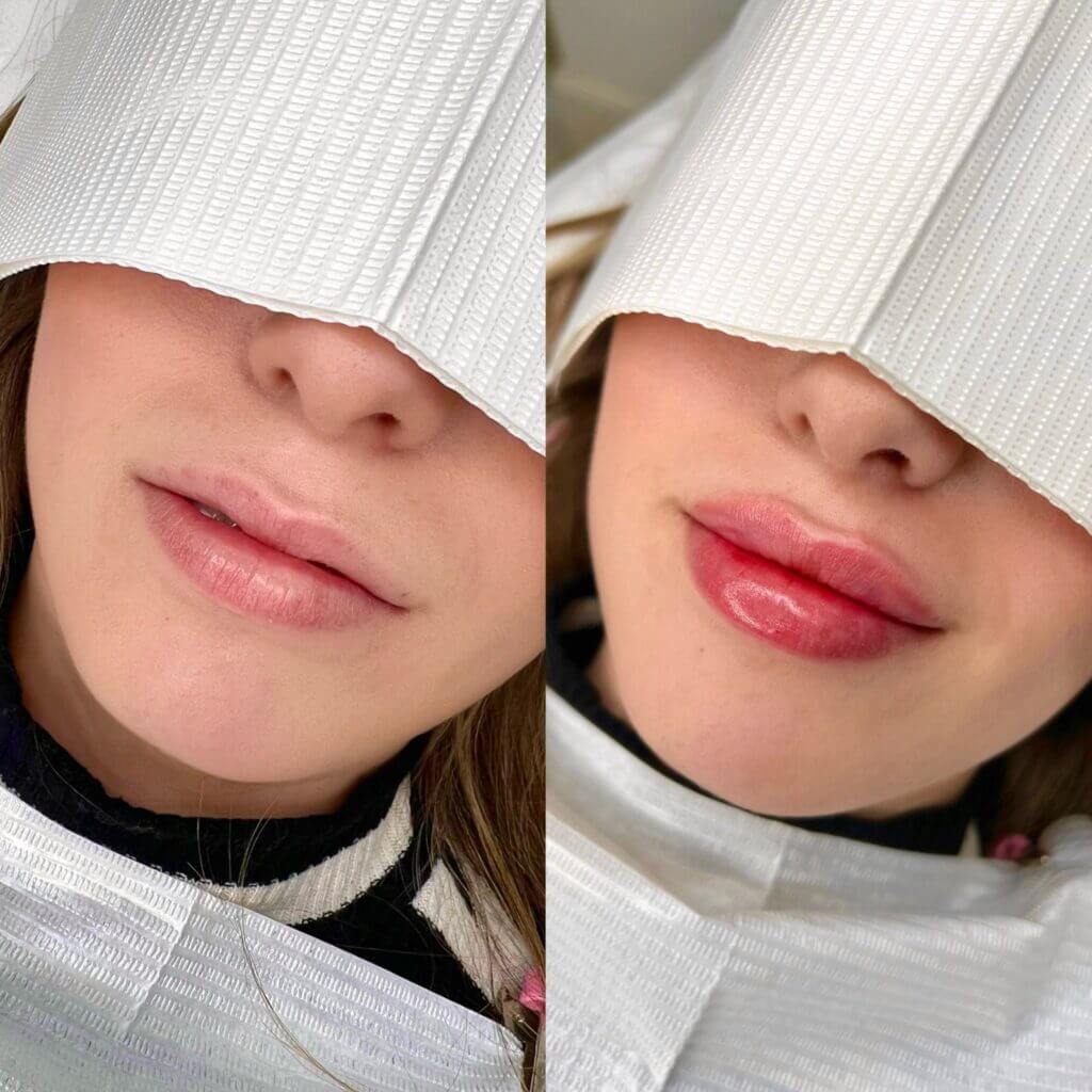 Servicio de Aumento de labios