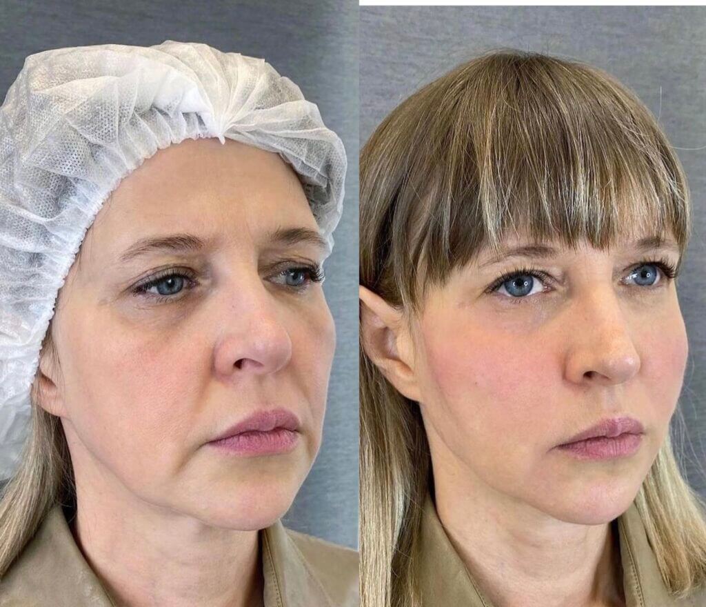 Comparativa del contorno facial en dos vistas de tres cuartos.