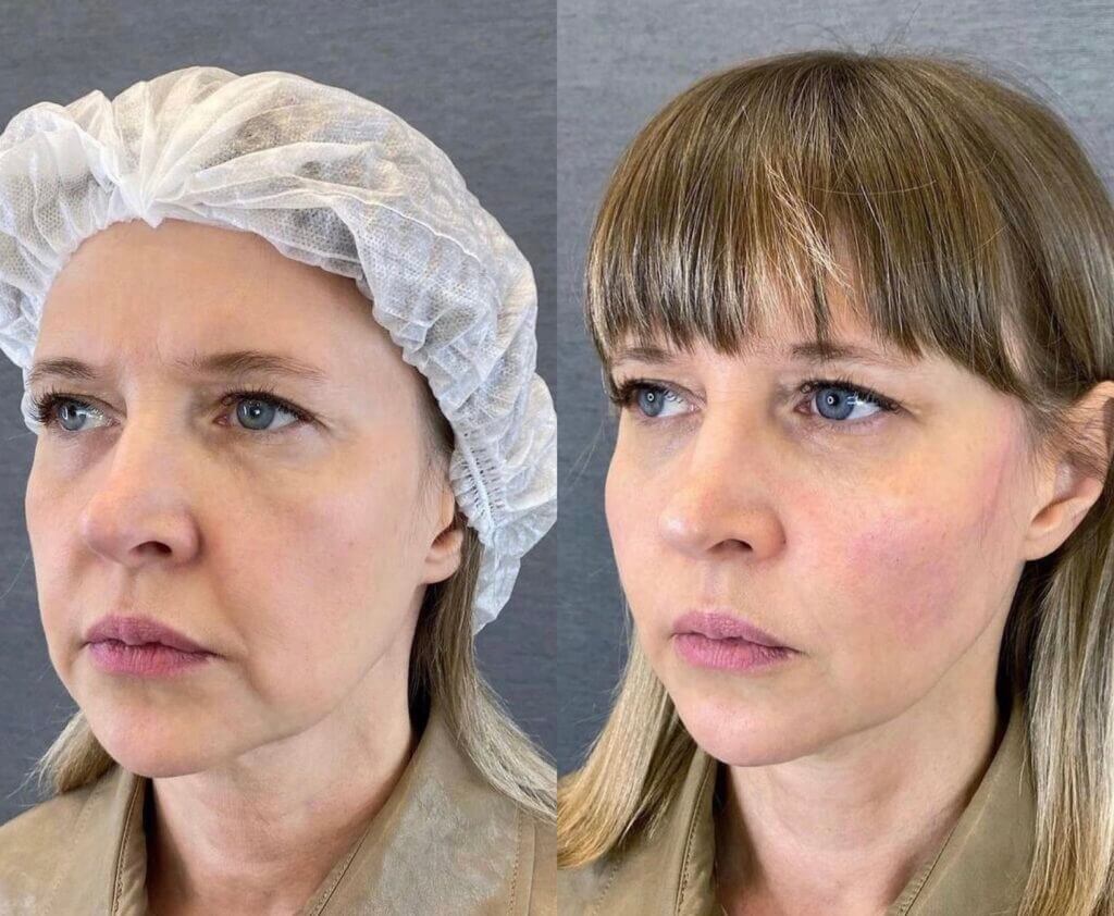 Dos vistas oblicuas para comparar mejillas, labios y línea mandibular.
