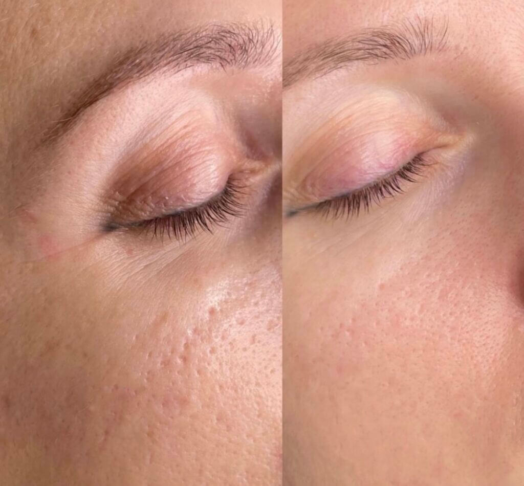 Antes y después de Morpheus 8 en rostro.