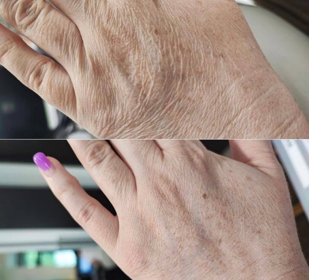 Antes y después de rejuvenecimiento de manos