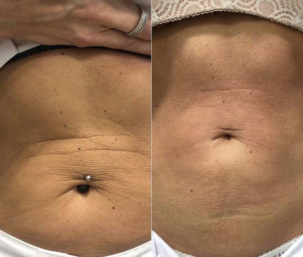Comparativa del abdomen y la textura de la piel alrededor del ombligo.