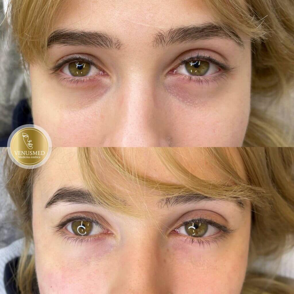 Comparativa frontal del contorno de los ojos en dos fotografías.