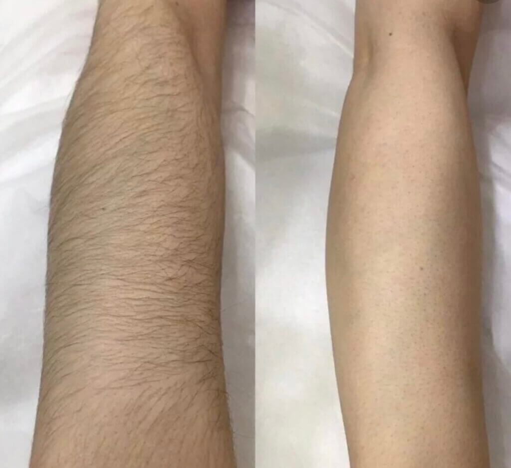 Comparativa de dos antebrazos con diferente cantidad de vello visible.
