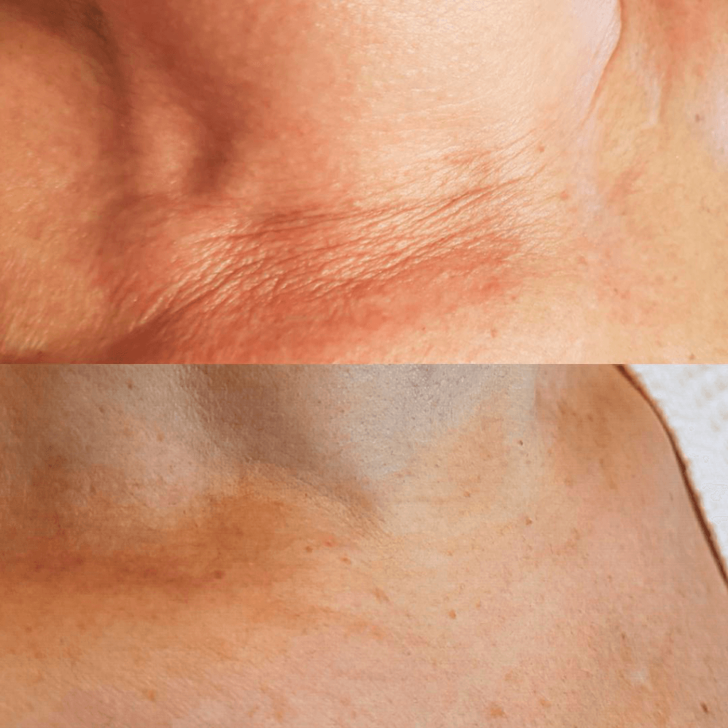 Comparativa de los pliegues y la textura de la piel del cuello.