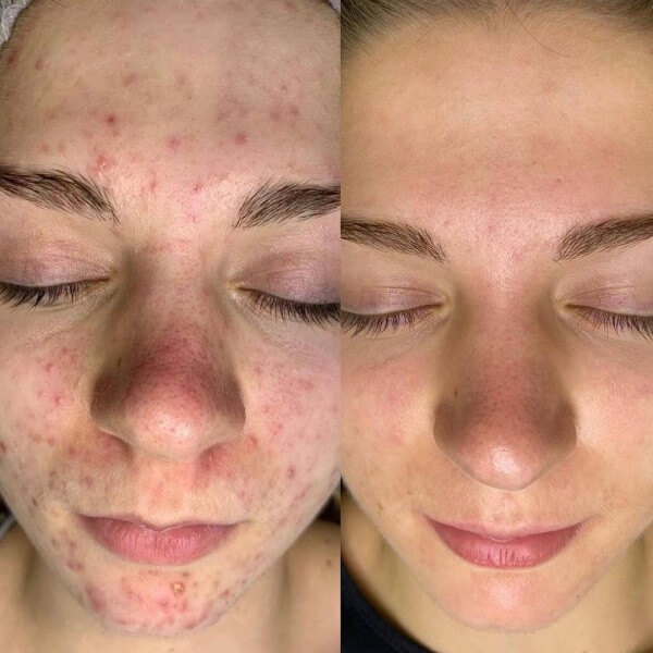 Comparativa frontal de la textura del rostro y las marcas rojizas de la piel.