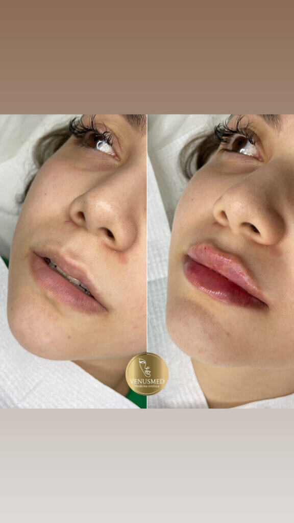 Comparativa de los labios y el perfil facial en dos fotografías oblicuas.