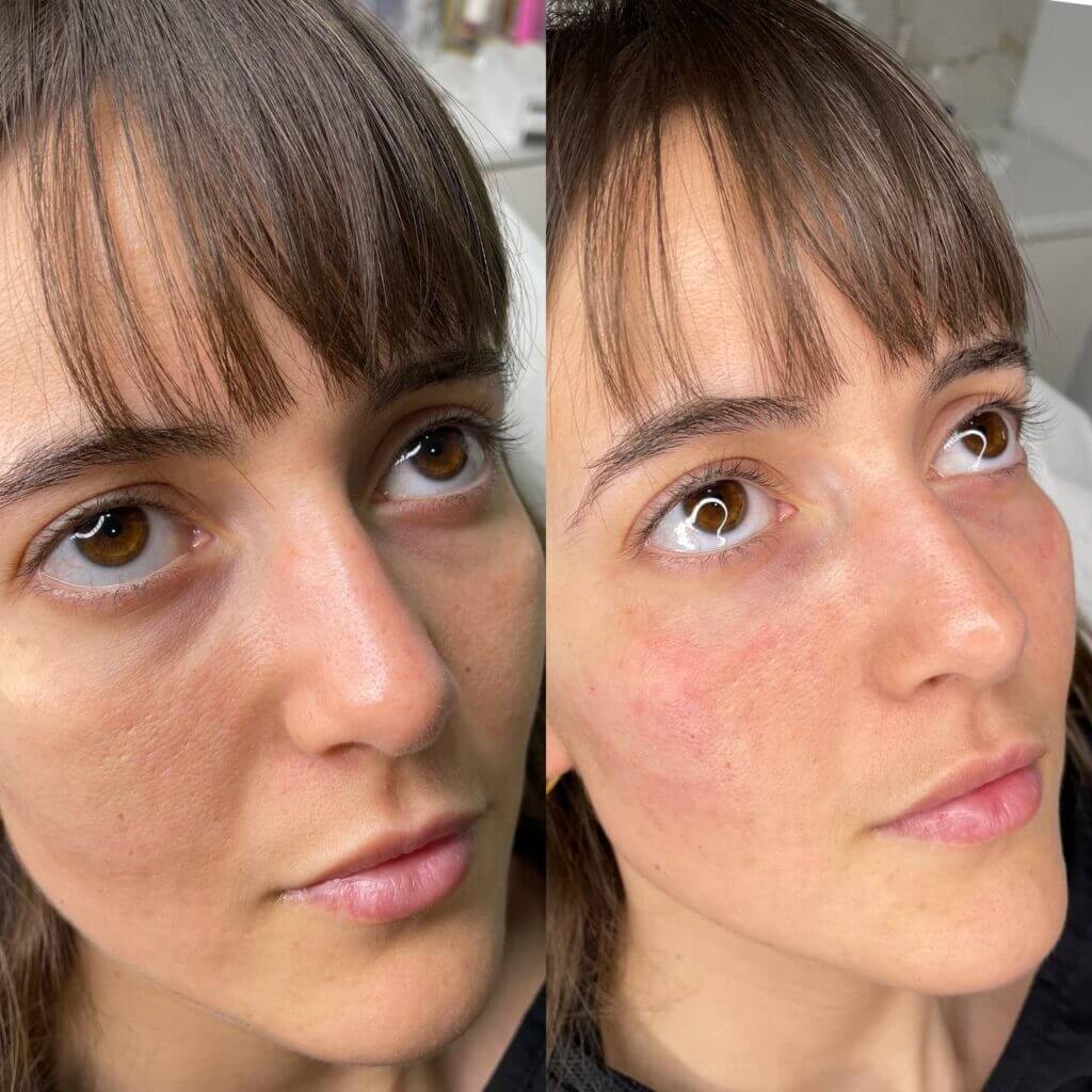 Comparativa del rostro, los pómulos y los labios en dos fotografías.