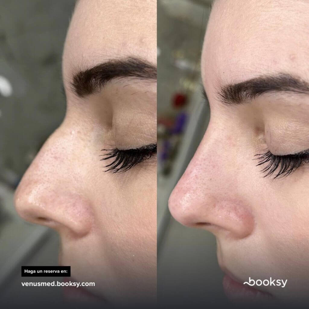 Comparativa lateral del perfil de la nariz en dos fotografías.