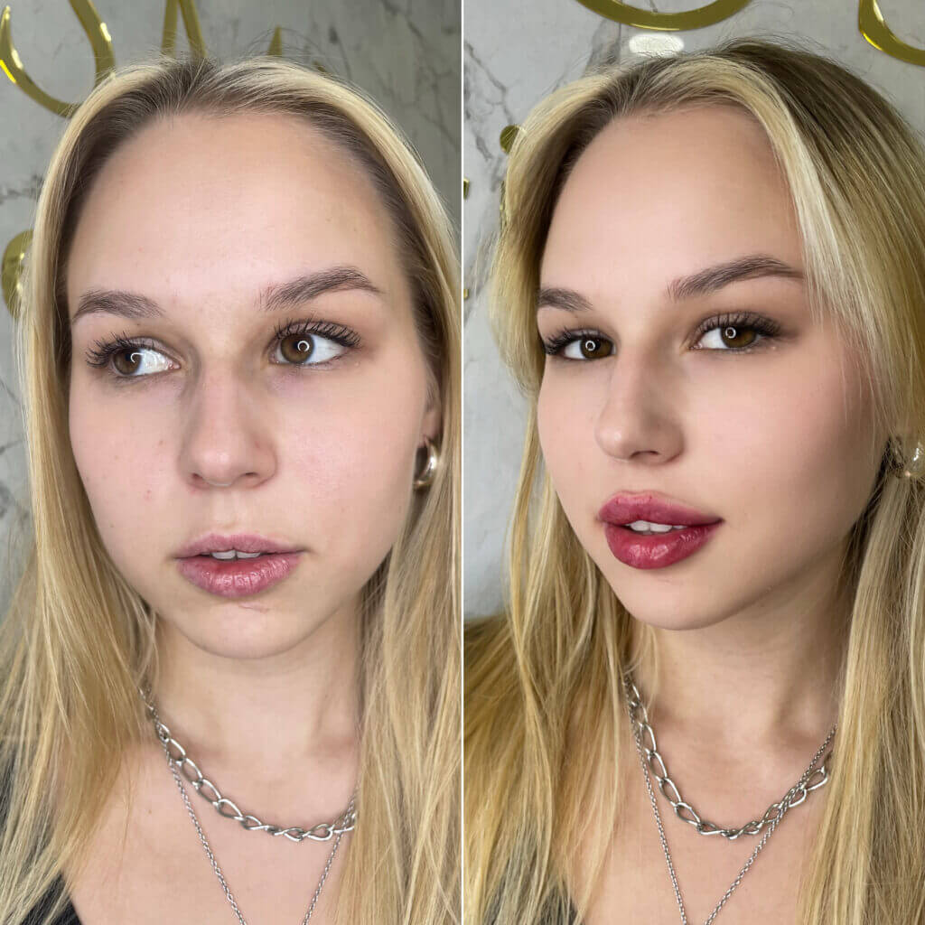 Comparativa frontal de la forma y el color de los labios.