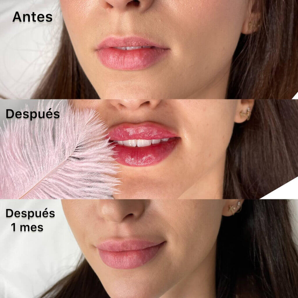 Comparativa labial rotulada «Antes», «Después» y «Después 1 mes».