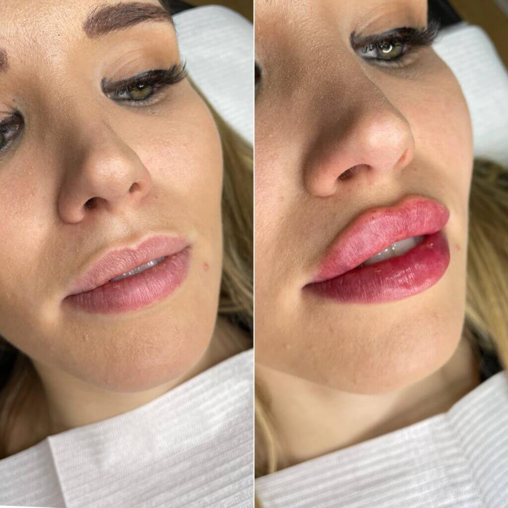 Detalle comparativo de los labios en dos fotografías de tres cuartos.
