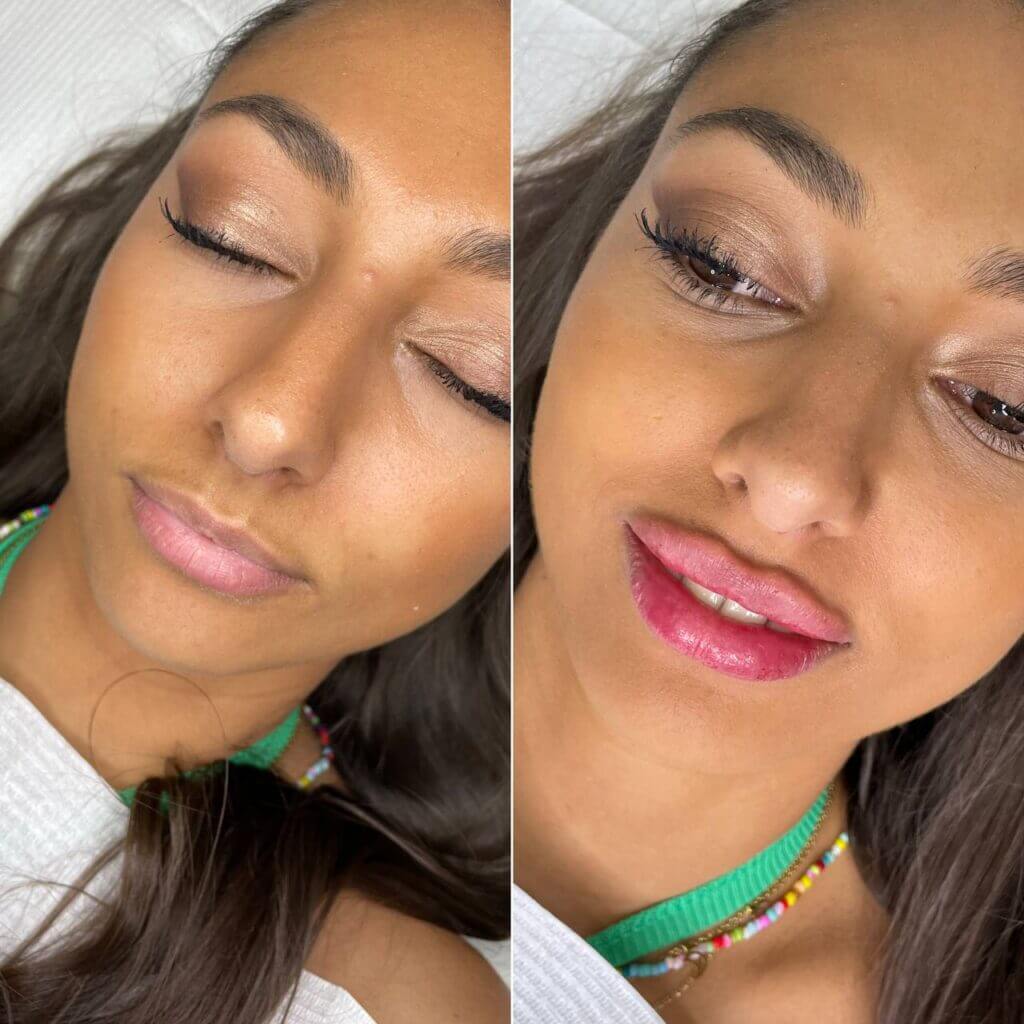 Dos fotografías del rostro para comparar el volumen y el contorno de los labios.