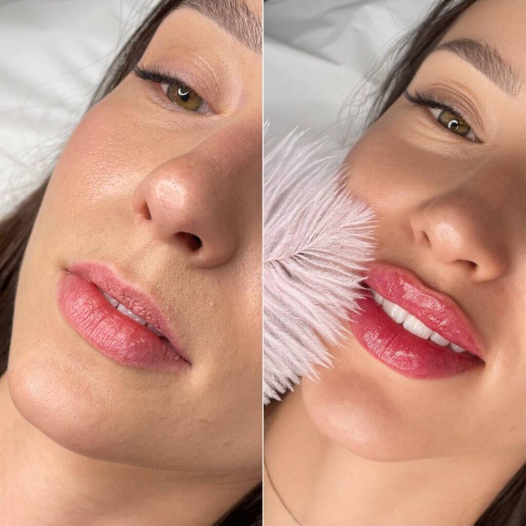 Comparativa del contorno y el color de los labios en dos vistas oblicuas.