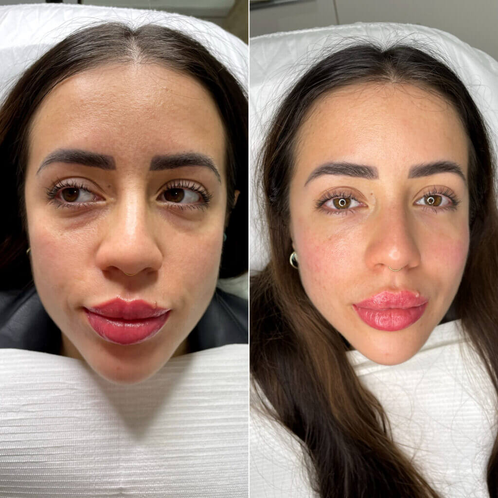 Tratamiento de ojeras con ácido hialurónico: dos vistas frontales del rostro para comparar la zona bajo los ojos.