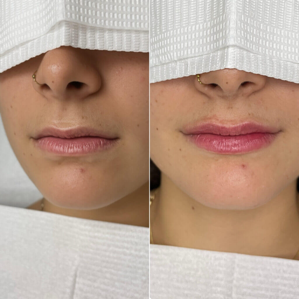 Comparativa frontal de los labios en dos fotografías.