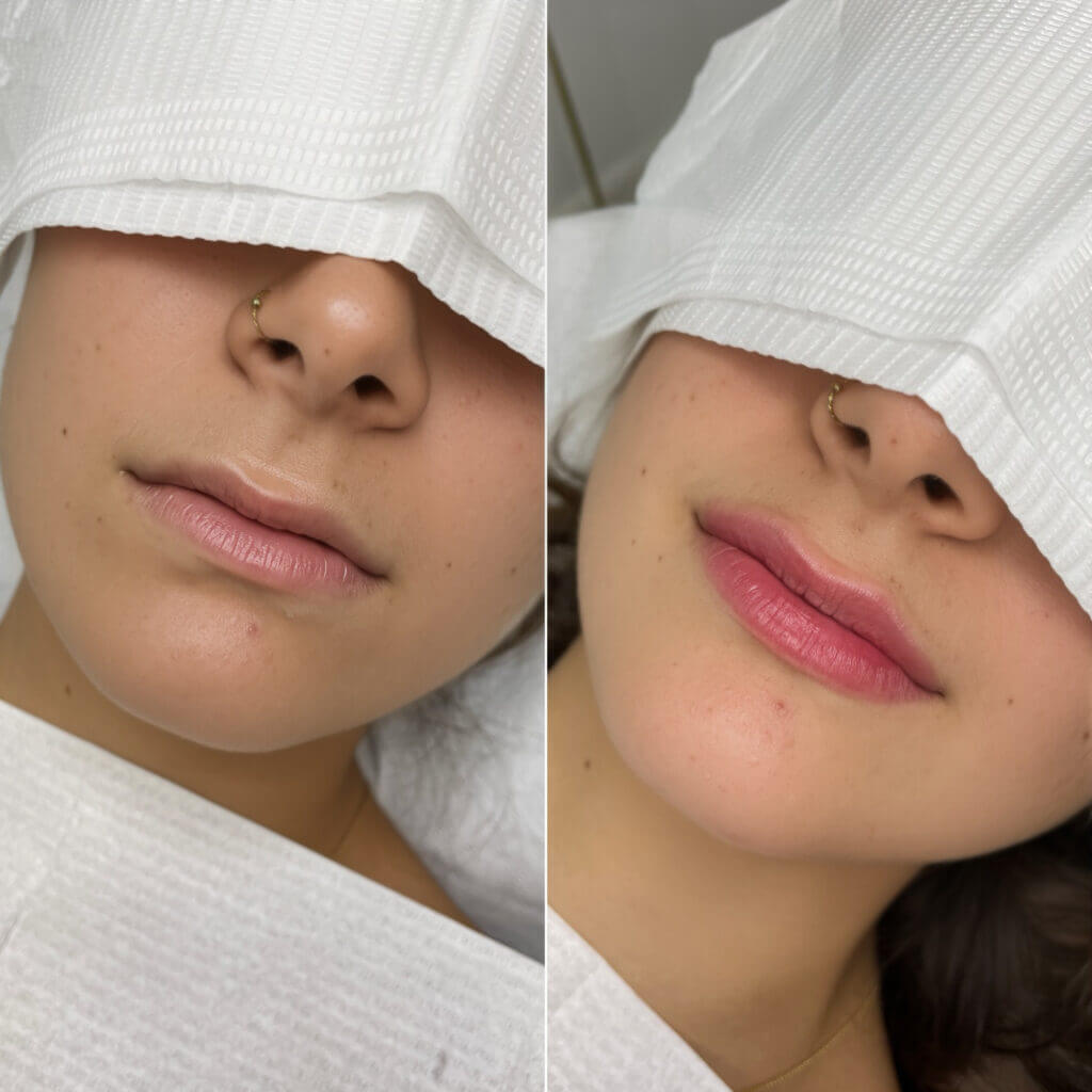 Comparativa de los labios en dos vistas oblicuas del rostro.