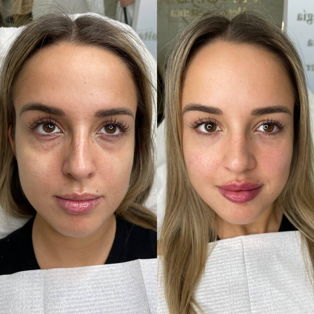 Tratamiento de ojeras con ácido hialurónico: dos fotografías frontales del rostro con el contorno de los ojos visible.