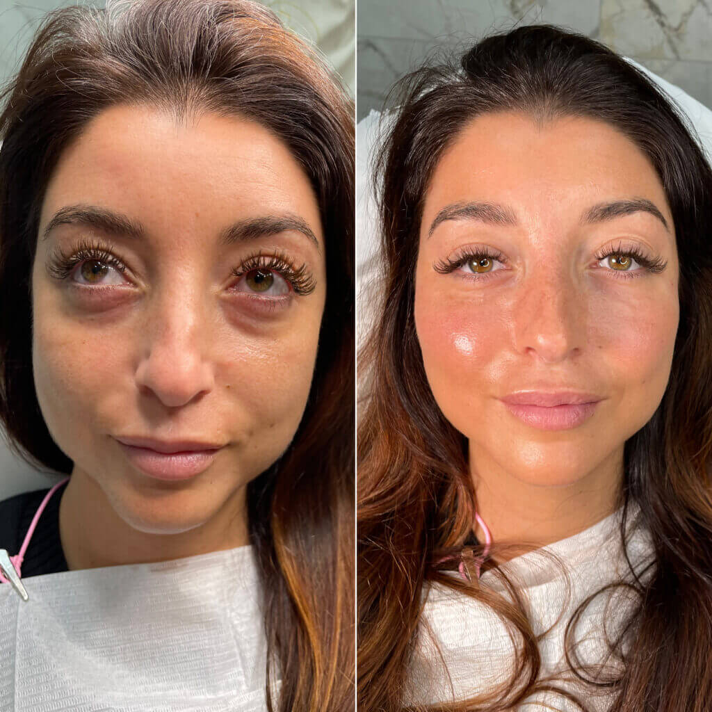 Antes y después de tratamiento de hidratación labial