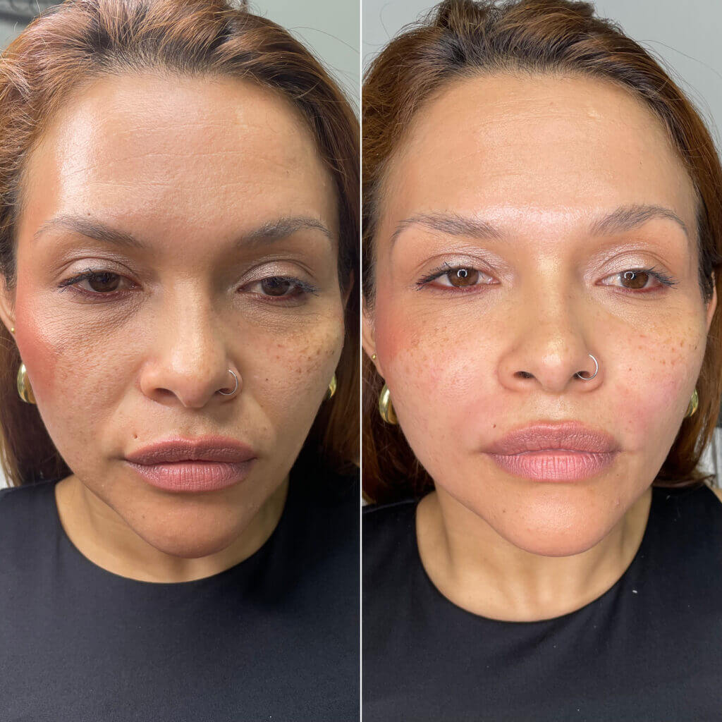 Antes y después de relleno de surcos nasogenianos con ácido hialurónico