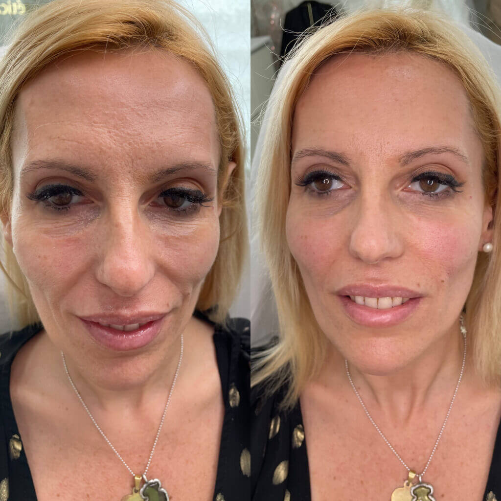 Mejora natural de surcos nasogenianos en VenusMed