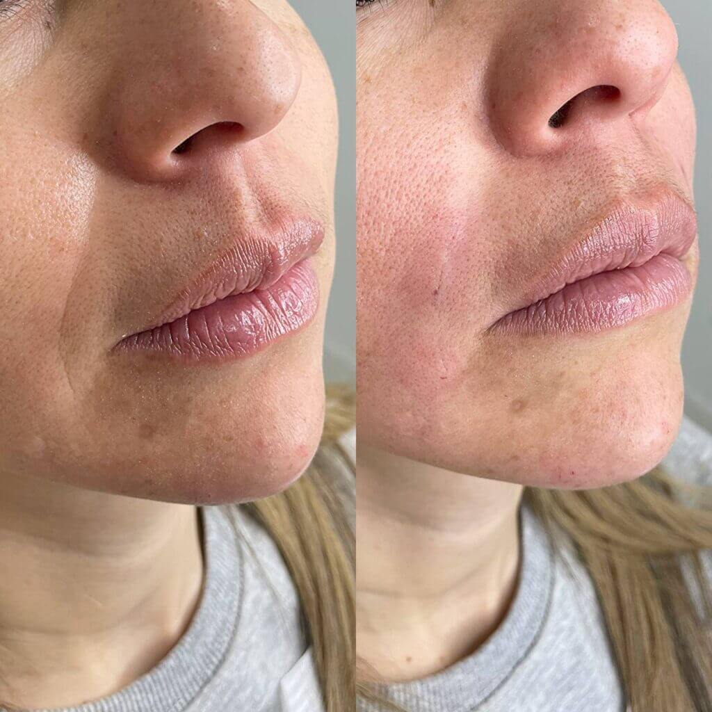 Tratamiento facial que suaviza líneas profundas y surcos