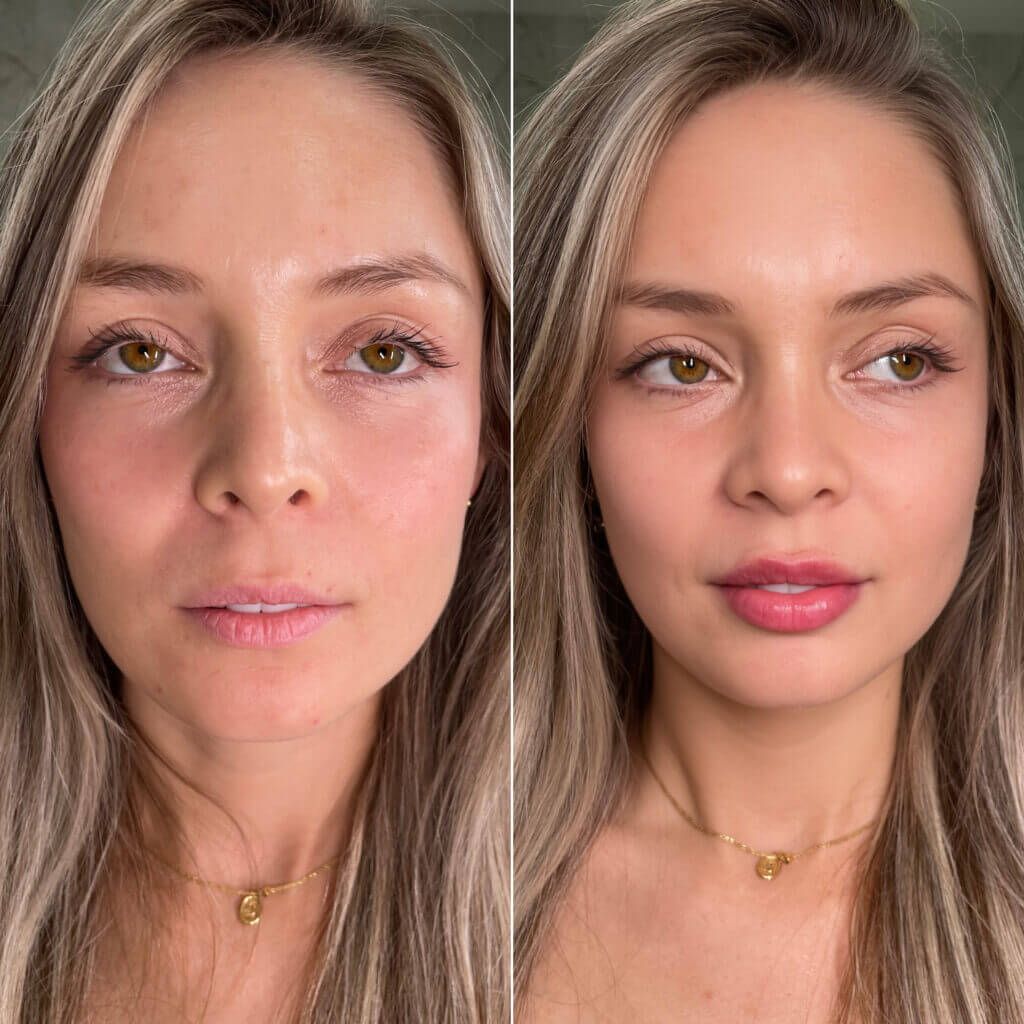 Antes y después de Russian Lips en VenusMed