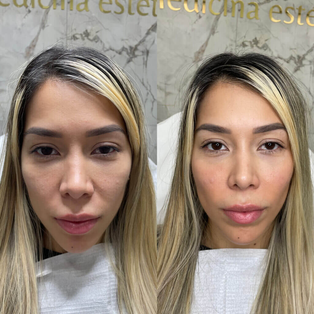 Pómulos más definidos y voluminosos tras tratamiento