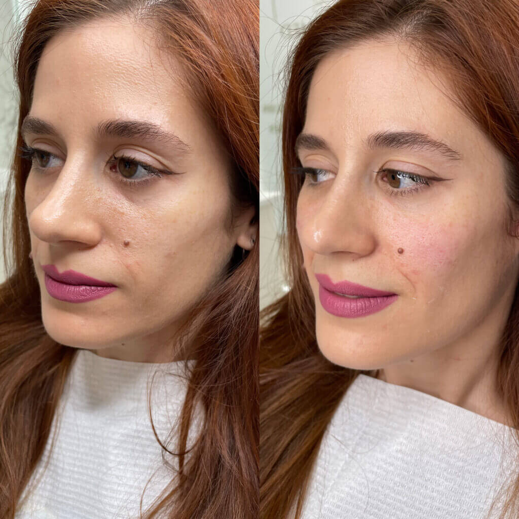 Perfil facial armonizado con aumento de pómulos