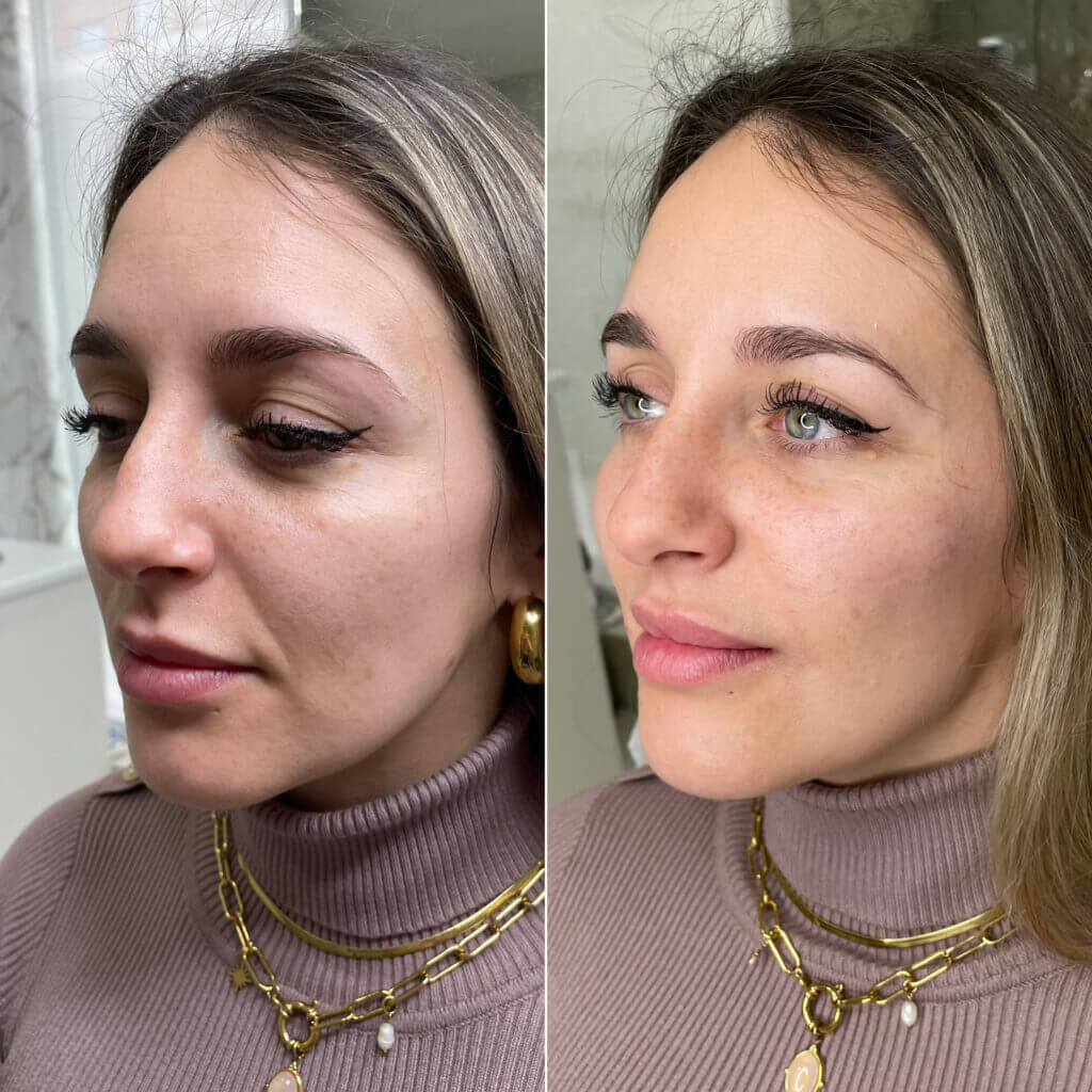 Tratamiento estético para realzar pómulos naturales