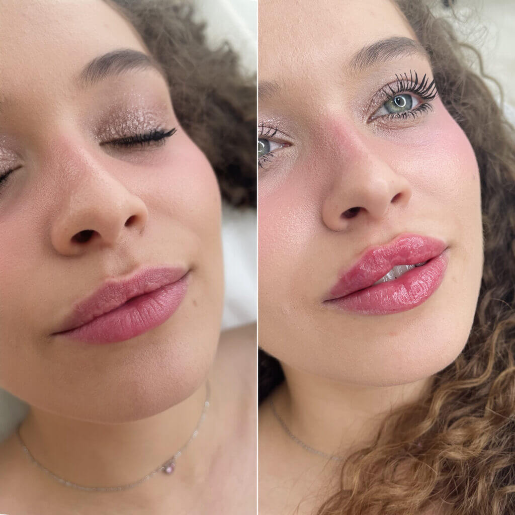 Comparativa oblicua de los labios y el rostro en dos fotografías.