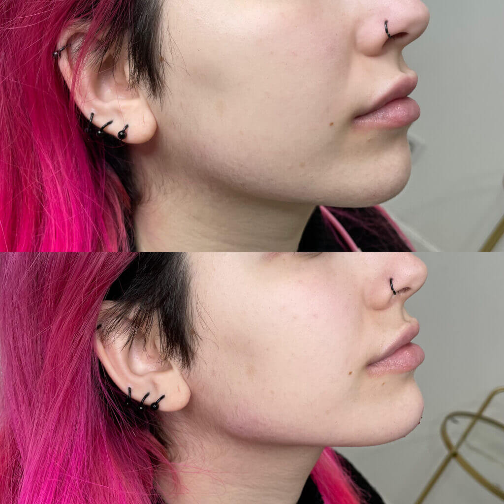 Detalle comparativo de perfil del mentón y la línea mandibular.