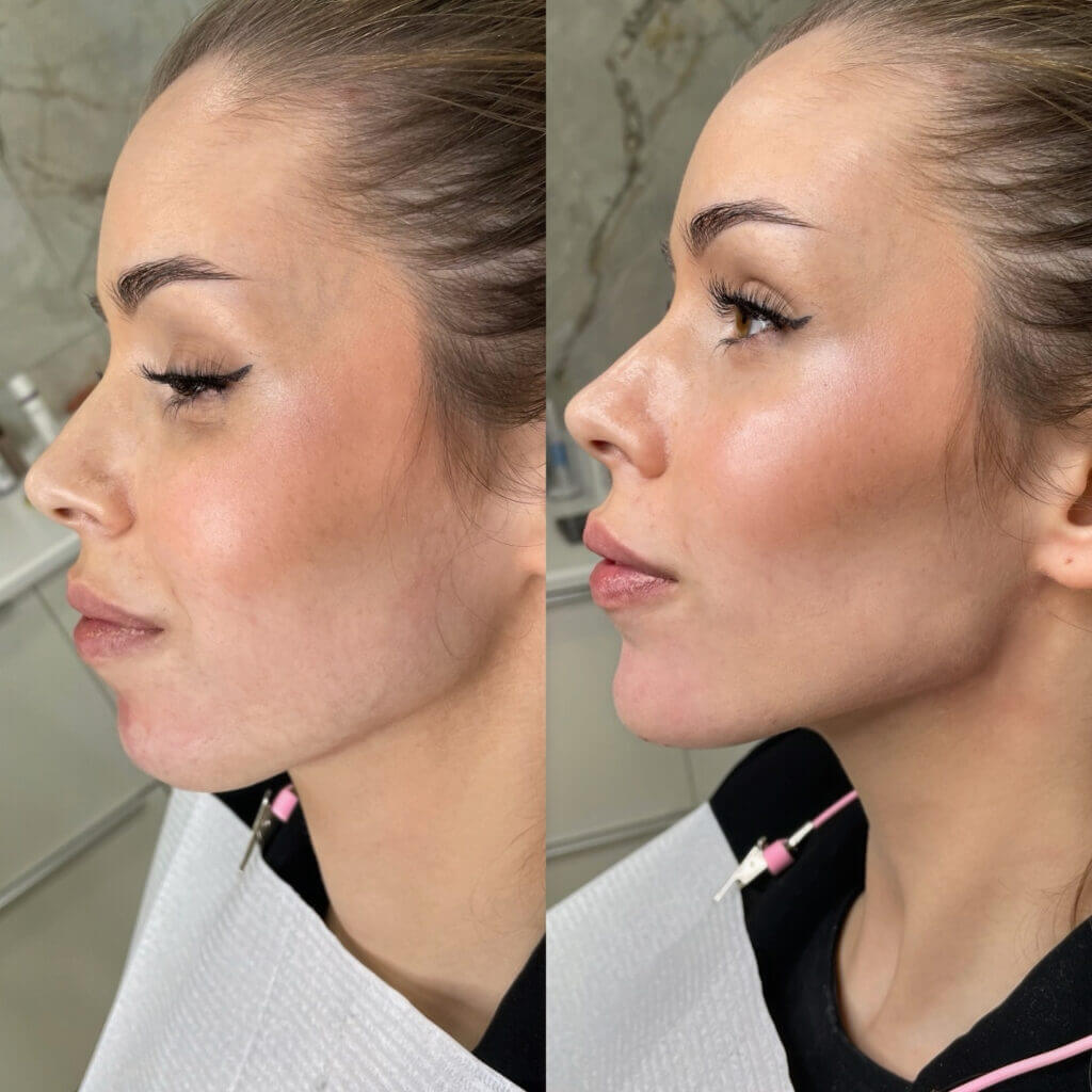 Comparativa lateral del perfil facial, la nariz y el mentón.