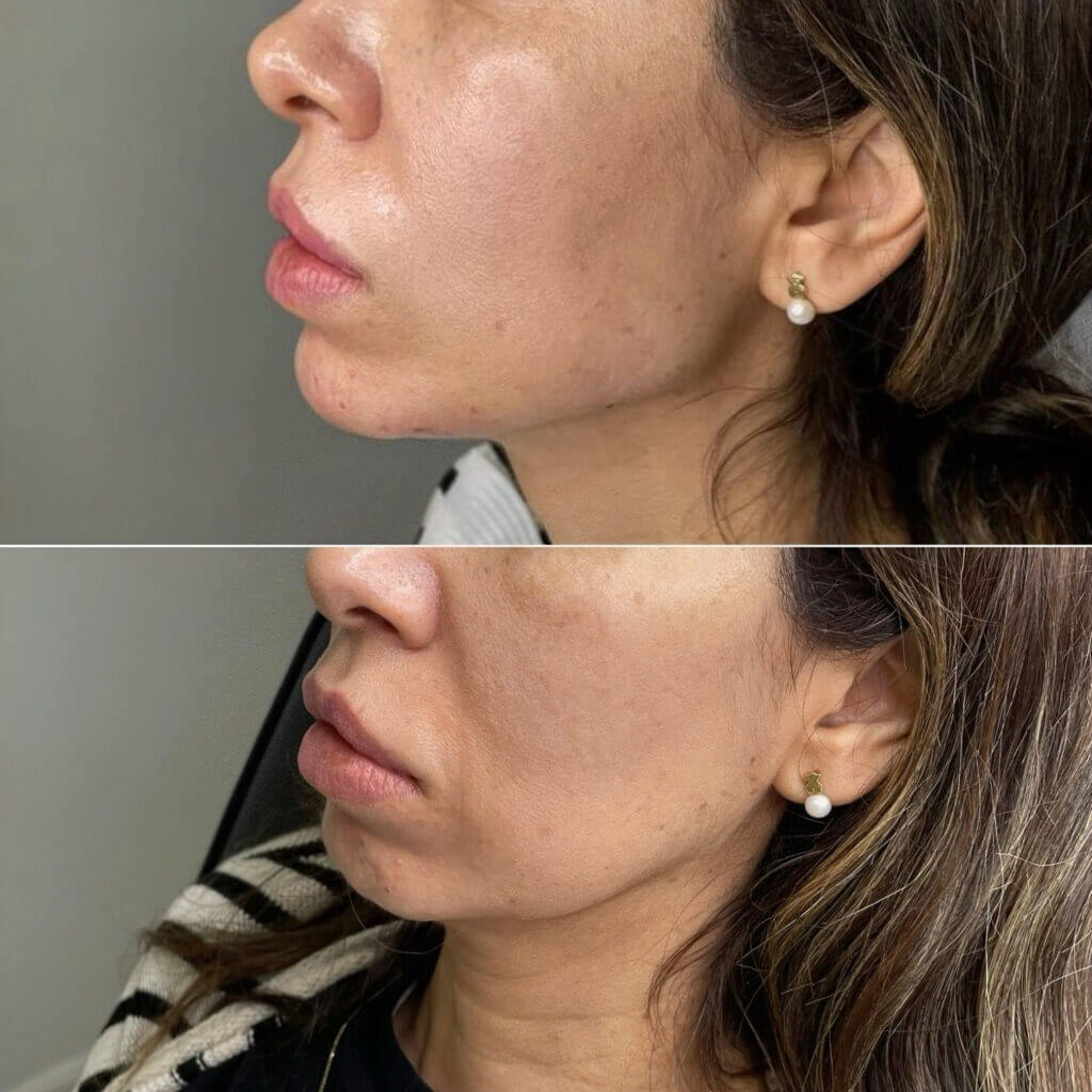 Resultados visibles de perfil facial mejorado con ácido hialurónico