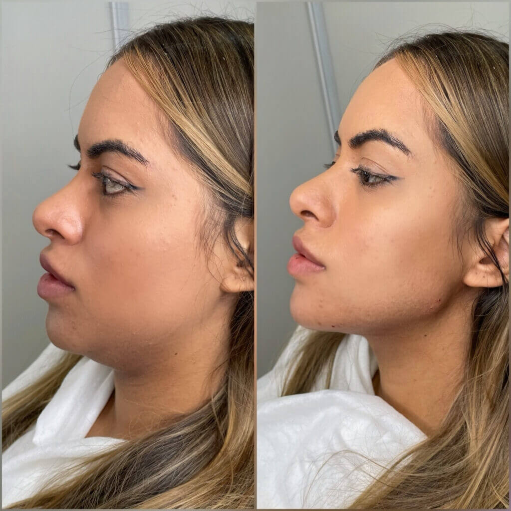 Tratamiento profesional para realzar la línea mandibular