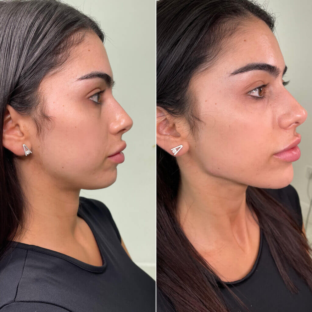 Perfil facial armonioso con marcación de mandíbula