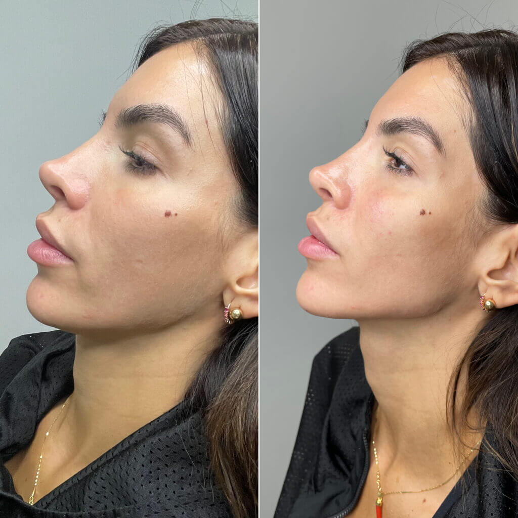 Transformación facial natural con marcación mandibular