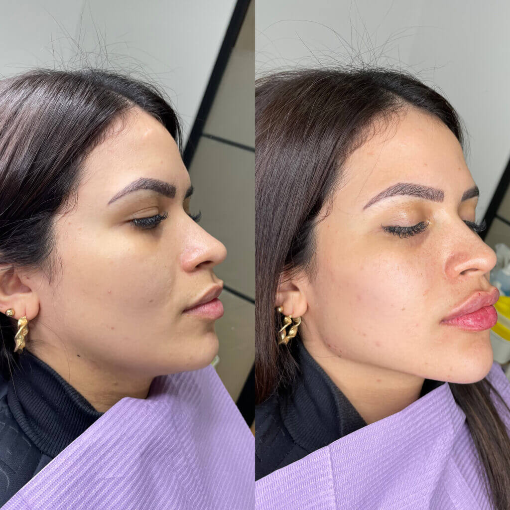 Comparativa de perfil de la nariz, los labios y el mentón.