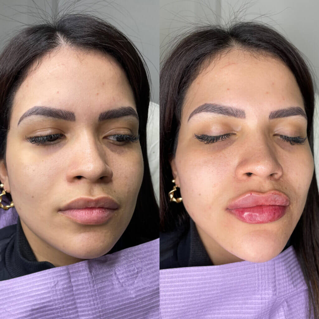 Dos vistas frontales para comparar labios, mentón y contorno facial.