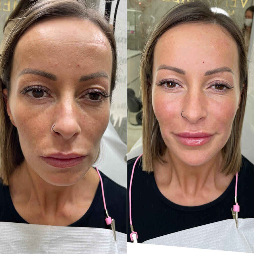 Comparativa frontal del rostro y de la zona de labios y mejillas.