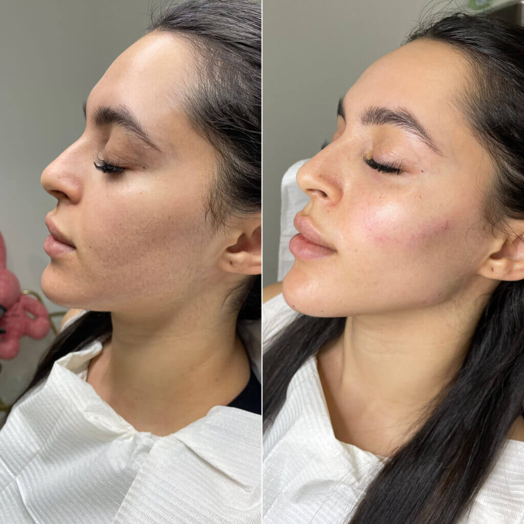 Dos fotografías de perfil del rostro con los ojos cerrados.