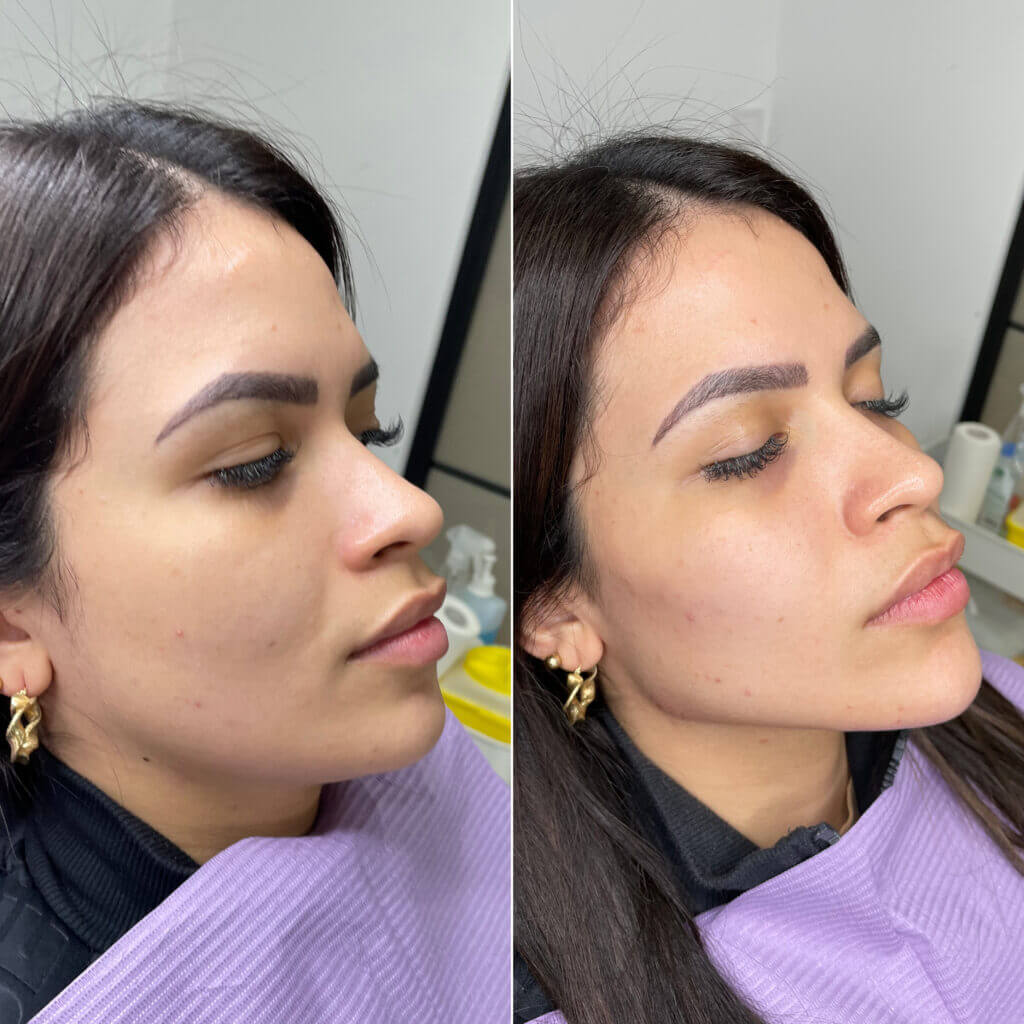 Comparativa oblicua de pómulos, labios y línea mandibular.