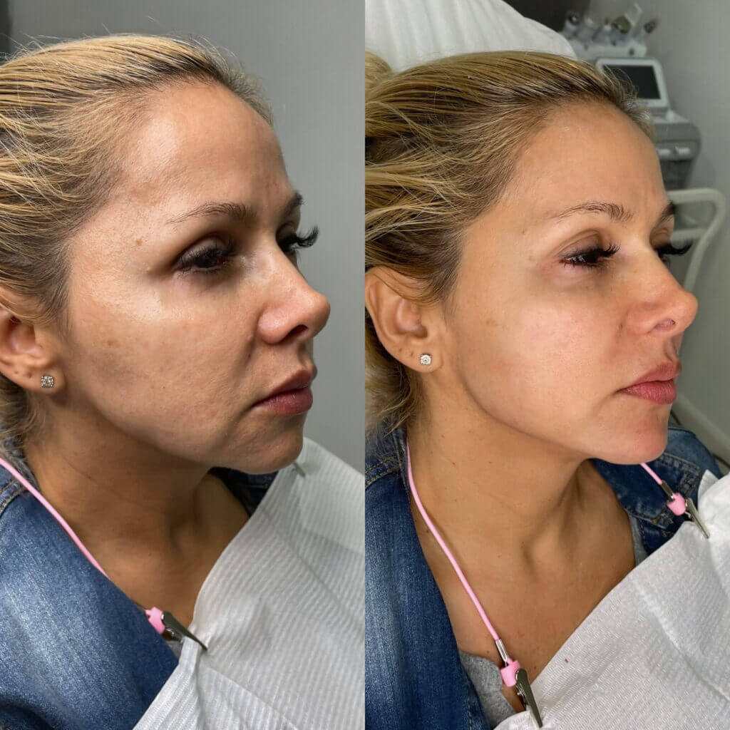 Comparativa lateral de las mejillas y el contorno del rostro.